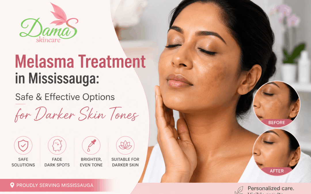 Woman receiving professional melasma treatment in Mississauga for safe hyperpigmentation removal on darker skin tones